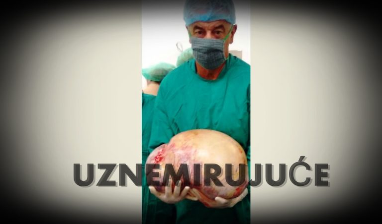 U Gospiću iz pacijentice izvadili najveći tumor dosad, težak je 20 kg